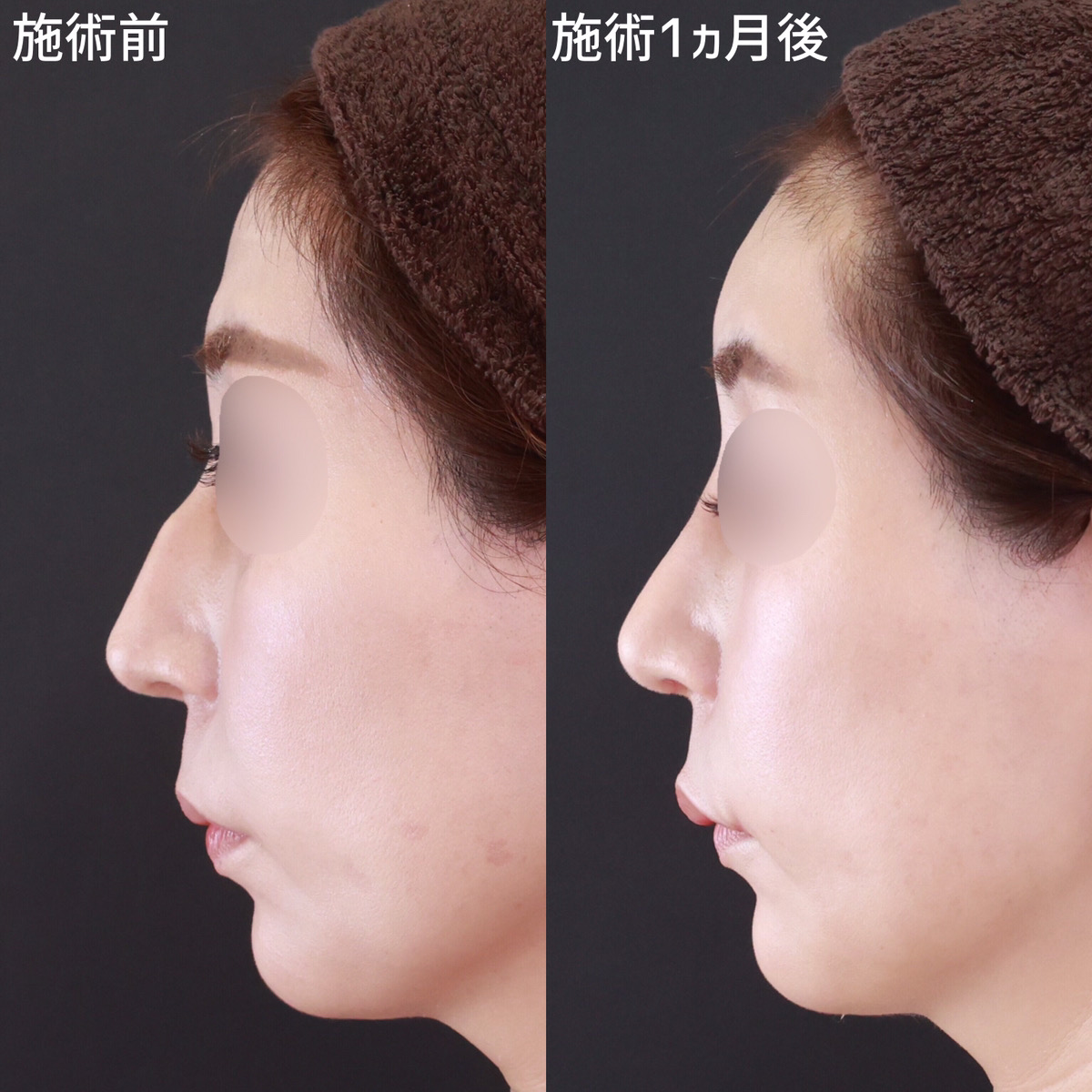 【わし鼻修正】女性らしいなめらかな鼻に