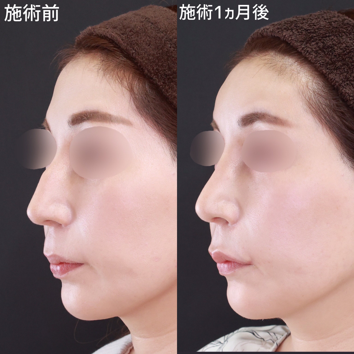 隆鼻術（プロテーゼ・自家組織）の症例写真 施術前後 