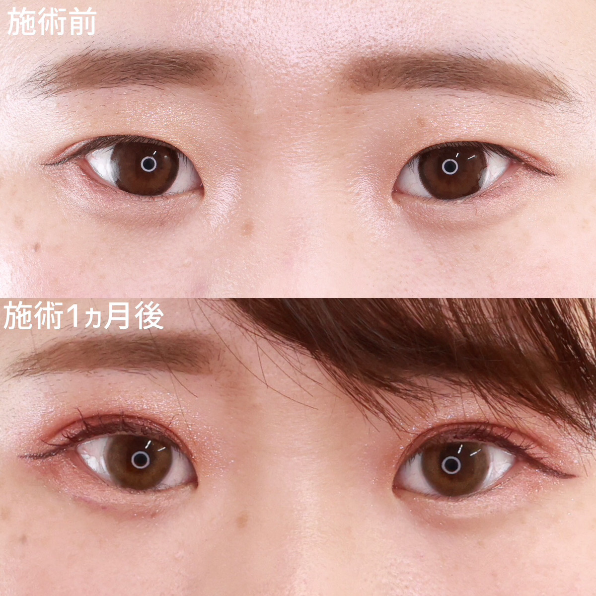 【二重埋没法】まつ毛の生え際が見え垢抜けeyeに変身！