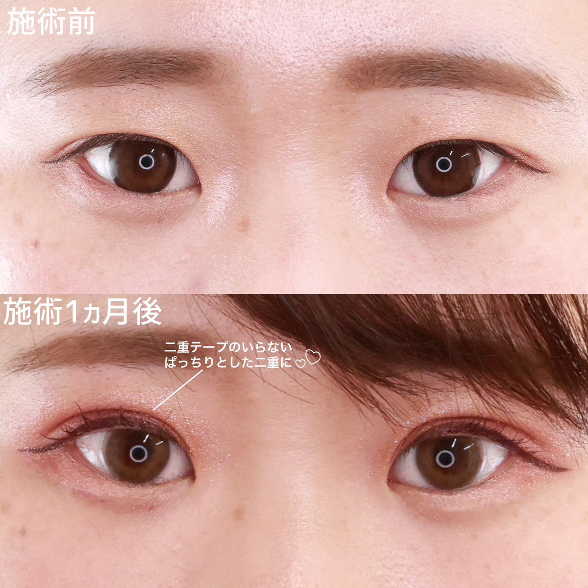 二重埋没法の症例写真 施術前後 