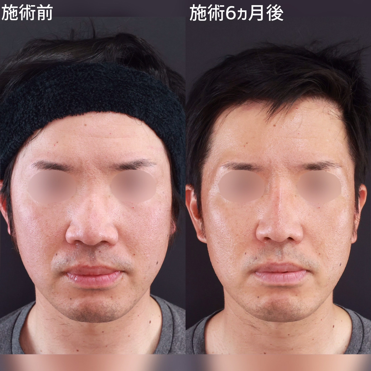 【鼻整形】鼻の厚みを解消し、スッと綺麗な忘れ鼻へ