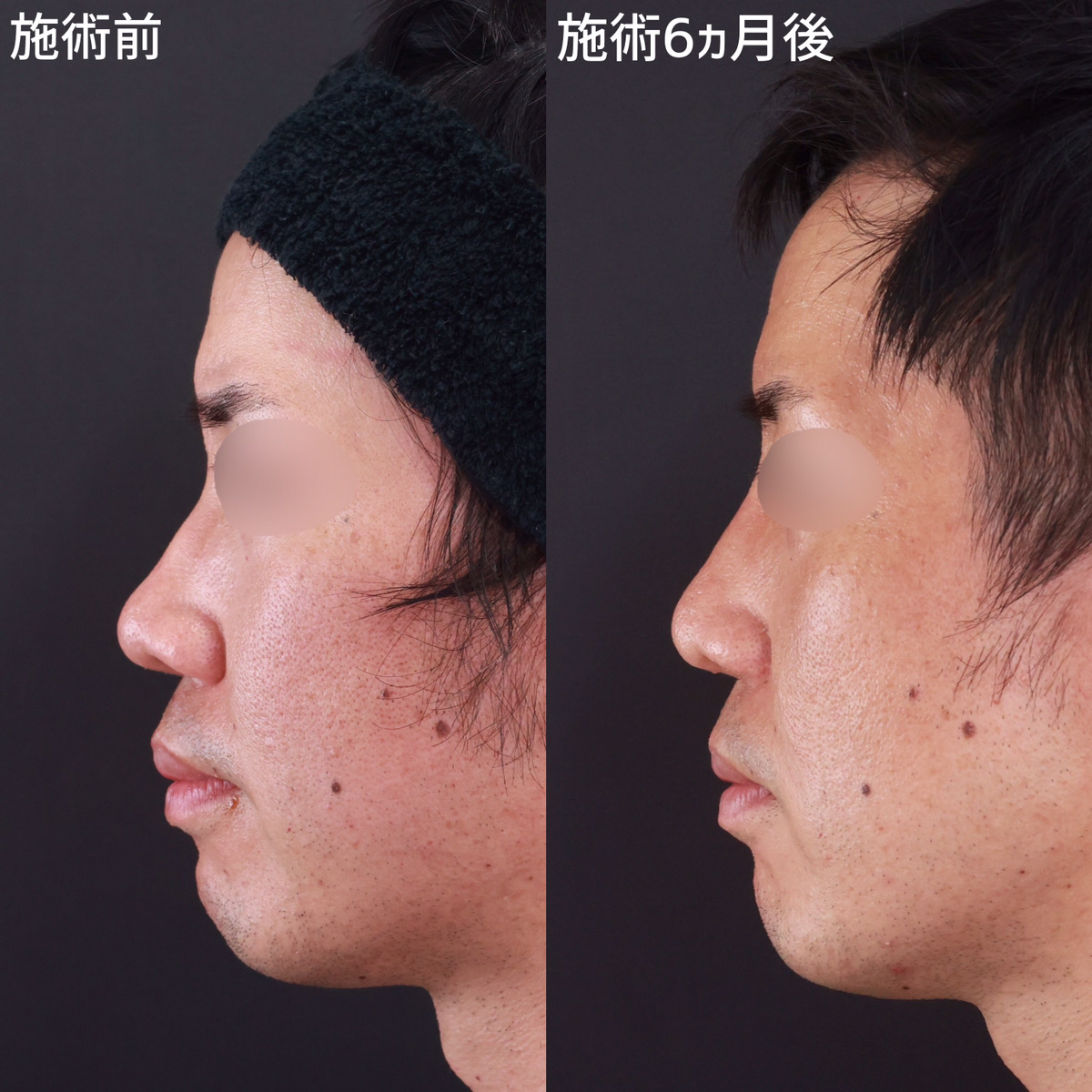 鼻尖形成・鼻尖縮小/鼻先軟骨移植/鼻翼挙上術の症例写真 施術前後 