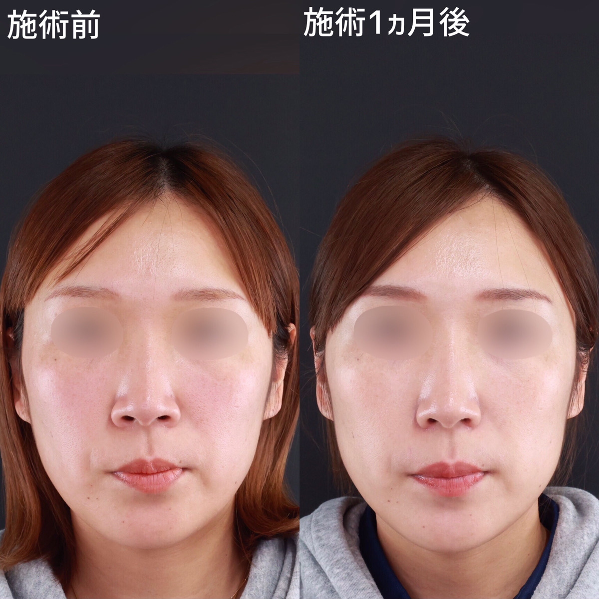 【小鼻縮小】悪目立ちしない、スッと綺麗な鼻へ