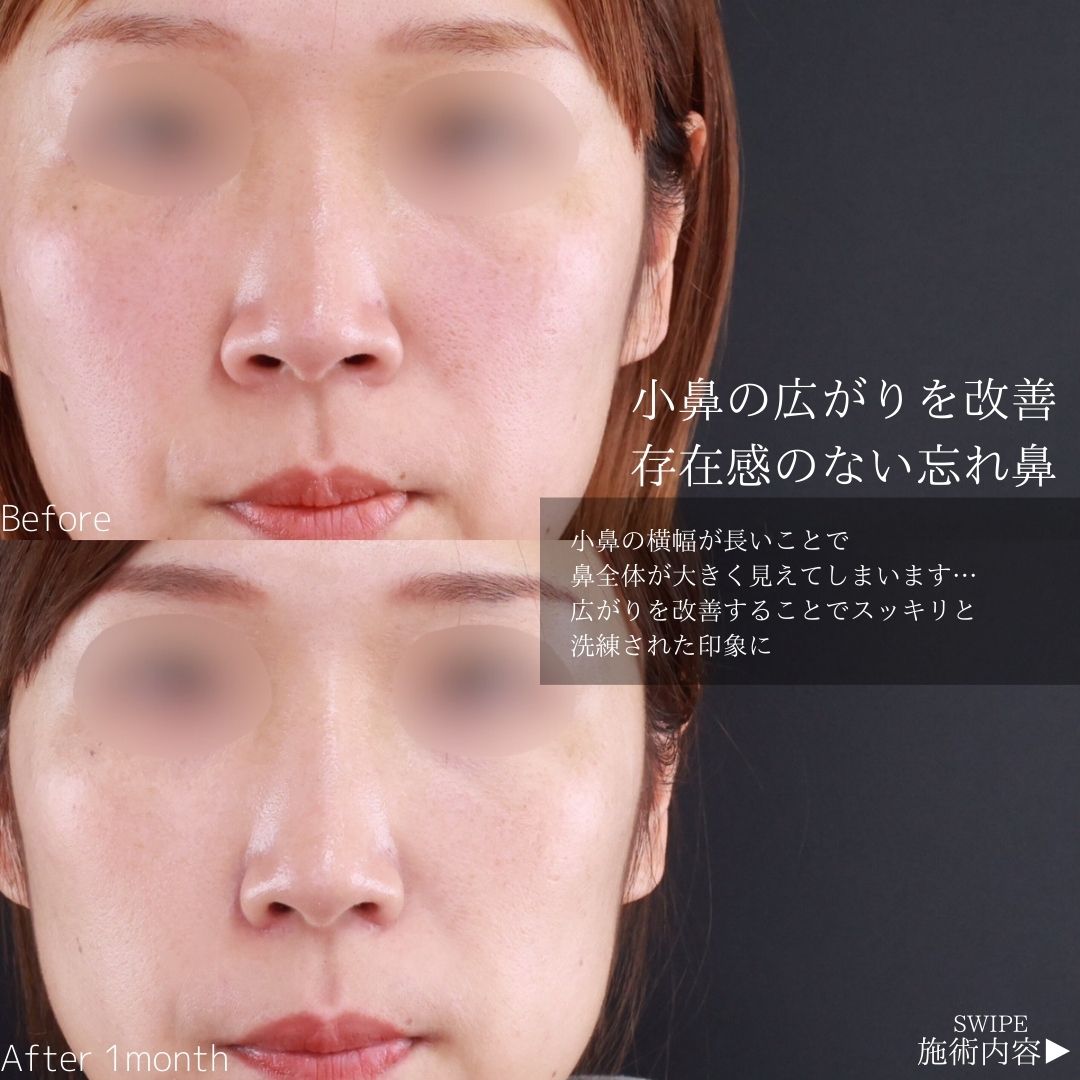 TAC式 鼻翼縮小術（小鼻縮小）の症例写真 施術前後 
