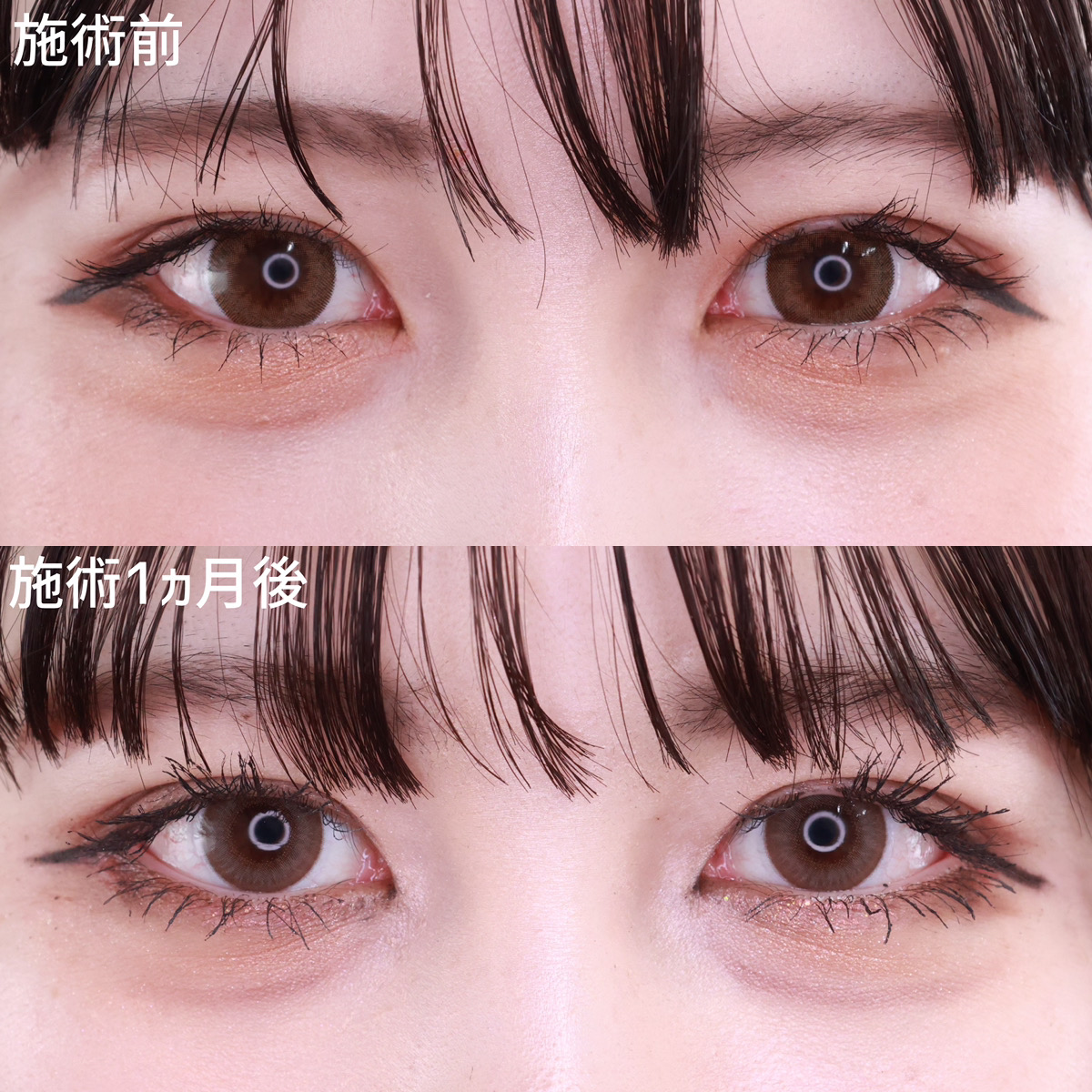 【タレ目尻切開】整形感のないナチュラルな可愛い目元