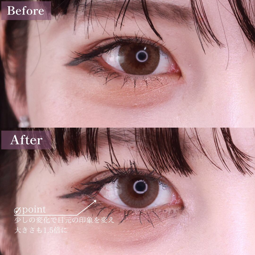 目尻切開術/目尻靭帯移動術の症例写真 施術前後 