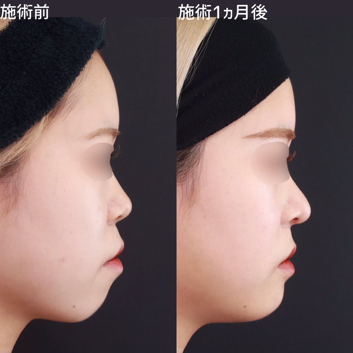 【鼻整形＋アゴのプロテーゼ】口コボを改善し横顔のラインを美しく！