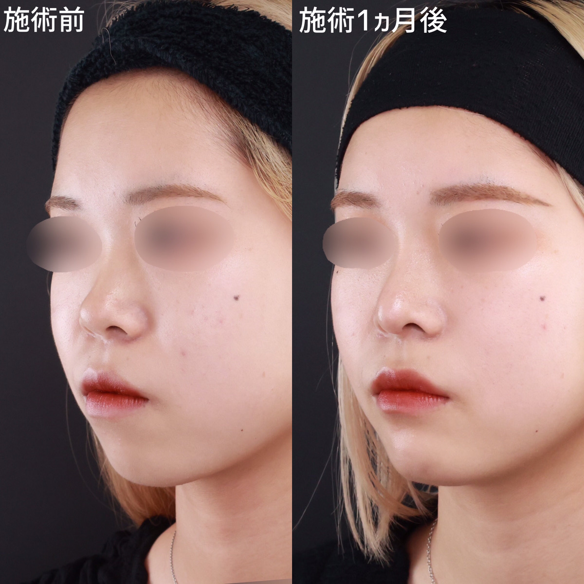 鼻尖形成・鼻尖縮小/鼻中隔延長術/鼻先軟骨移植の症例写真 施術前後 