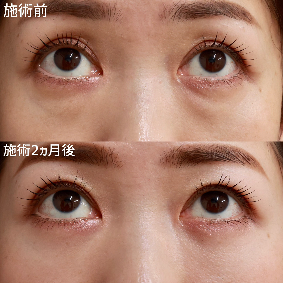 下眼瞼脱脂術（目の下のたるみ取り・目の下の脂肪ふくらみ取り）の症例写真 施術前後 