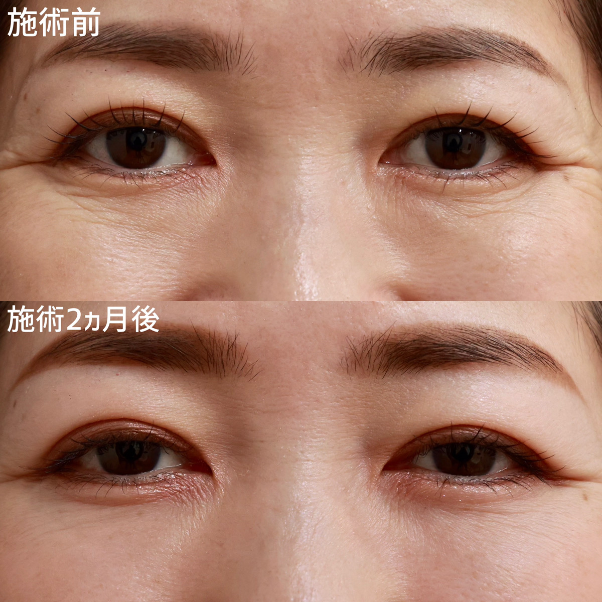 下眼瞼脱脂術（目の下のたるみ取り・目の下の脂肪ふくらみ取り）の症例写真 施術前後 