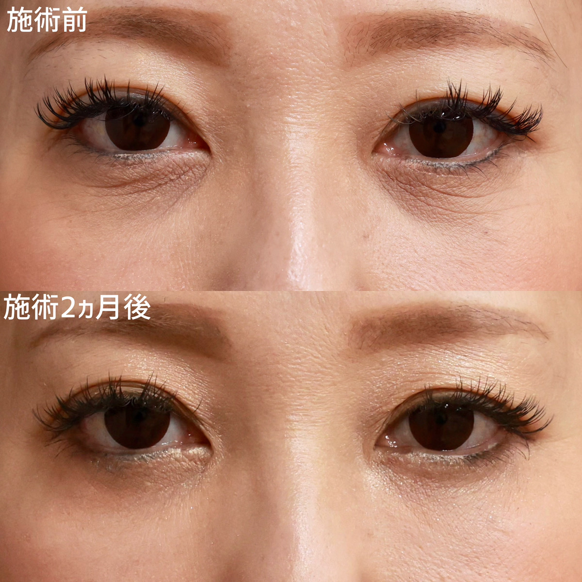 【目の下のたるみ取り】目元のシワを撃退！若々しい目元へ！