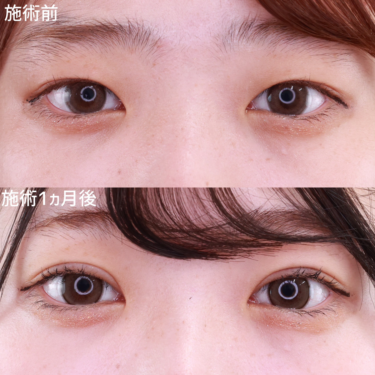 二重埋没法/目元:その他の症例写真 施術前後