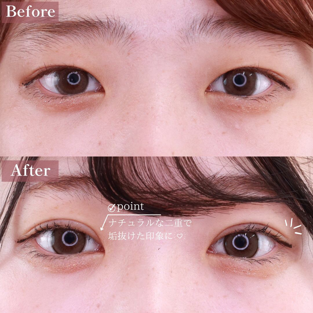二重埋没法/目元:その他の症例写真 施術前後