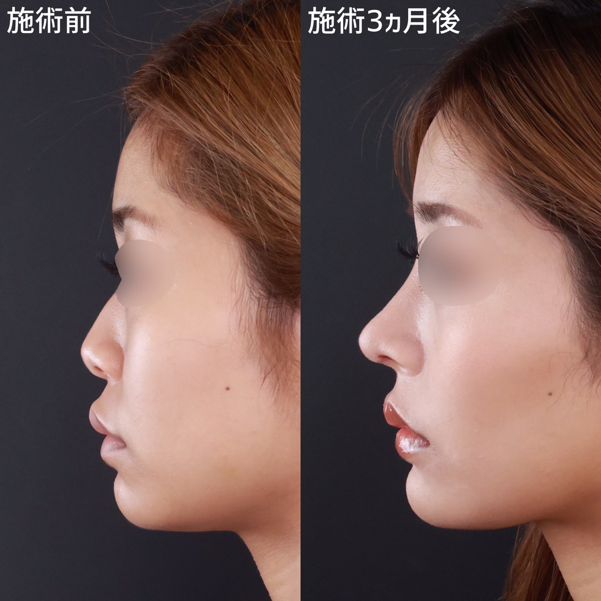 【鼻整形】鼻先に自然な丸みを残した「美鼻」に