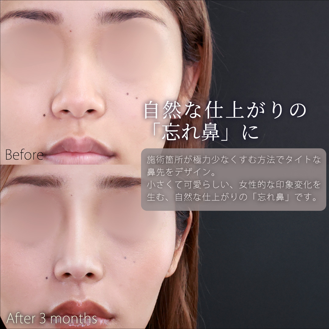 鼻尖形成・鼻尖縮小/鼻先軟骨移植/鼻中隔延長術の症例写真 施術前後 