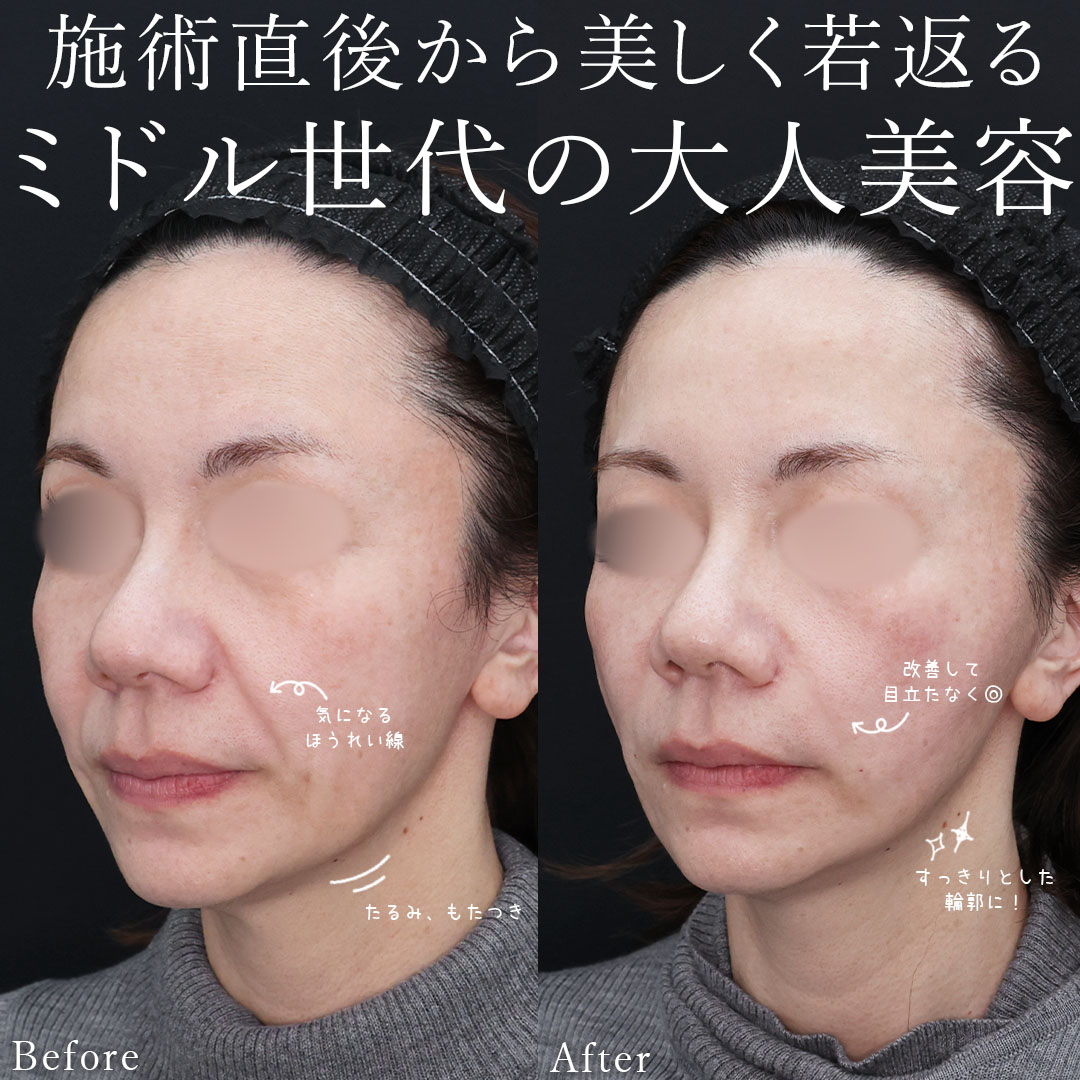 TAC式 ツヤ肌コラーゲンリフト®/ほうれい線のヒアルロン酸注射の症例写真 施術前後 