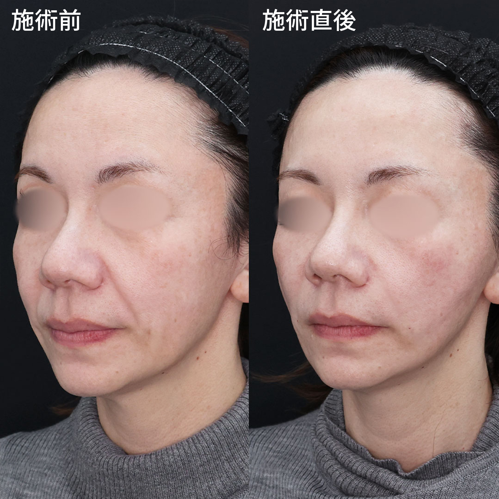 【糸リフト×ヒアルロン酸】施術直後から若返るオトナ美容