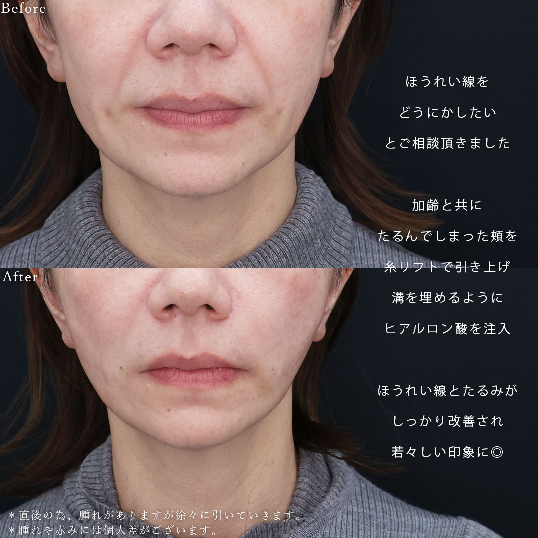TAC式 ツヤ肌コラーゲンリフト®/ほうれい線のヒアルロン酸注射の症例写真 施術前後 