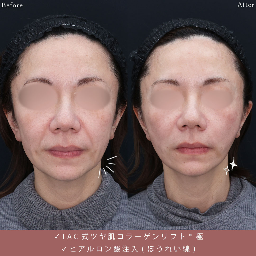 TAC式 ツヤ肌コラーゲンリフト®/ほうれい線のヒアルロン酸注射の症例写真 施術前後 