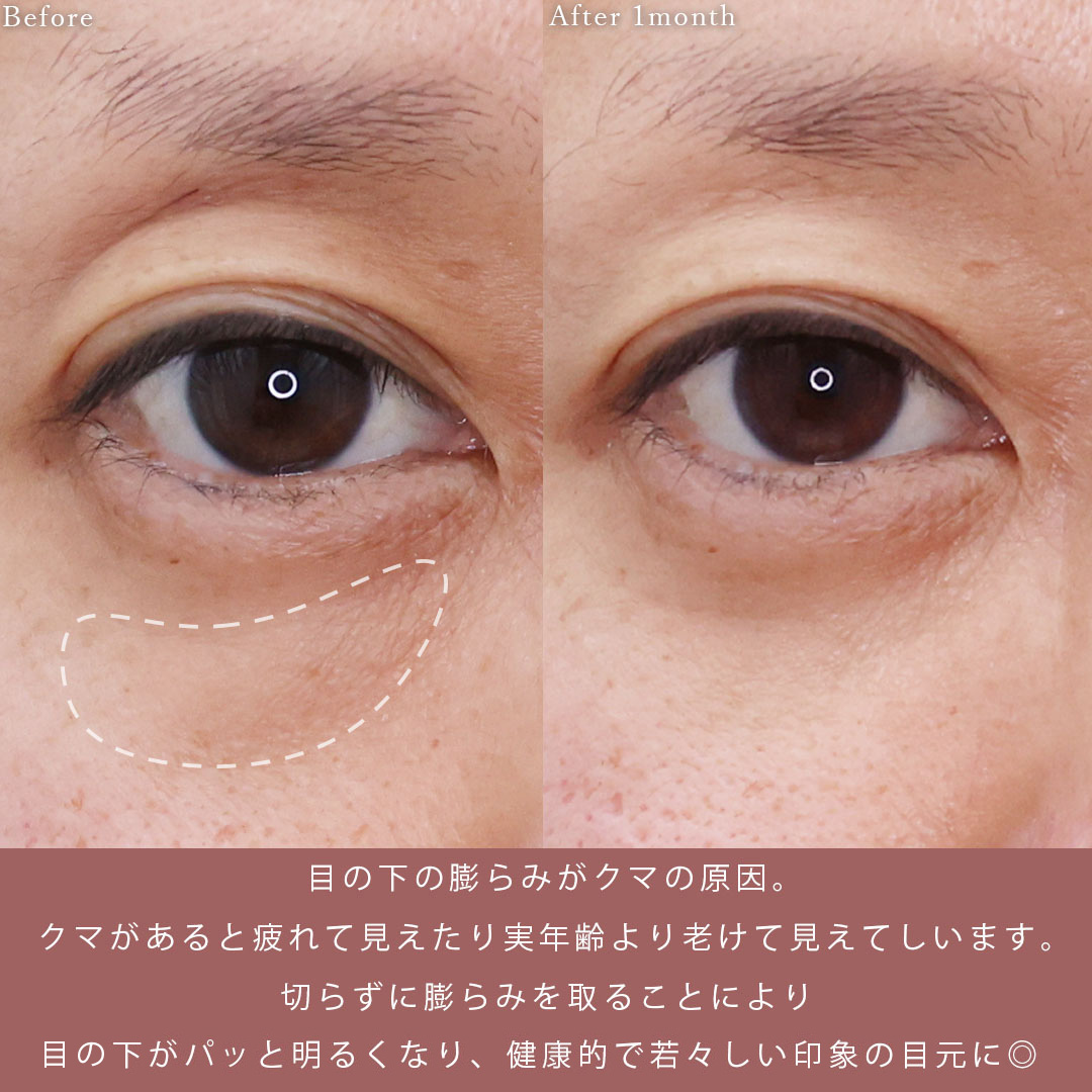 下眼瞼脱脂術（目の下のたるみ取り・目の下の脂肪ふくらみ取り）の症例写真 施術前後 