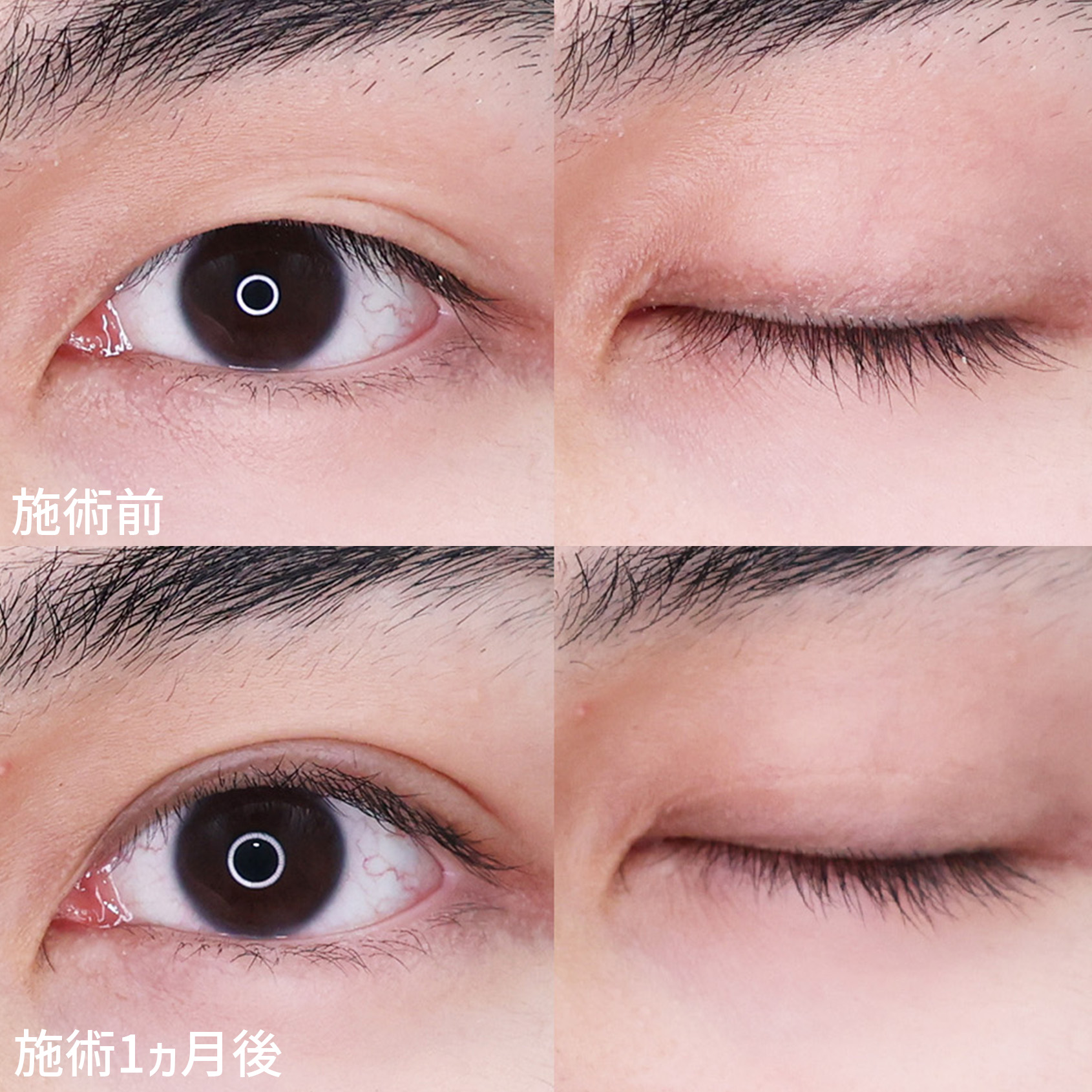 二重埋没法の症例写真 施術前後 