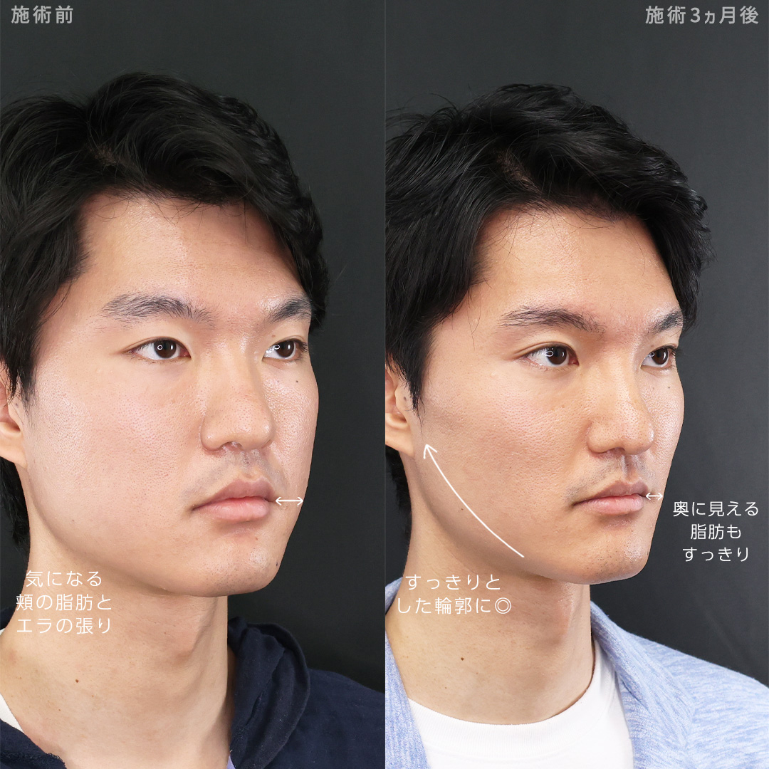 TAC式 ツヤ肌コラーゲンリフト®/ジョールファット除去/バッカルファット除去の症例写真 施術前後 