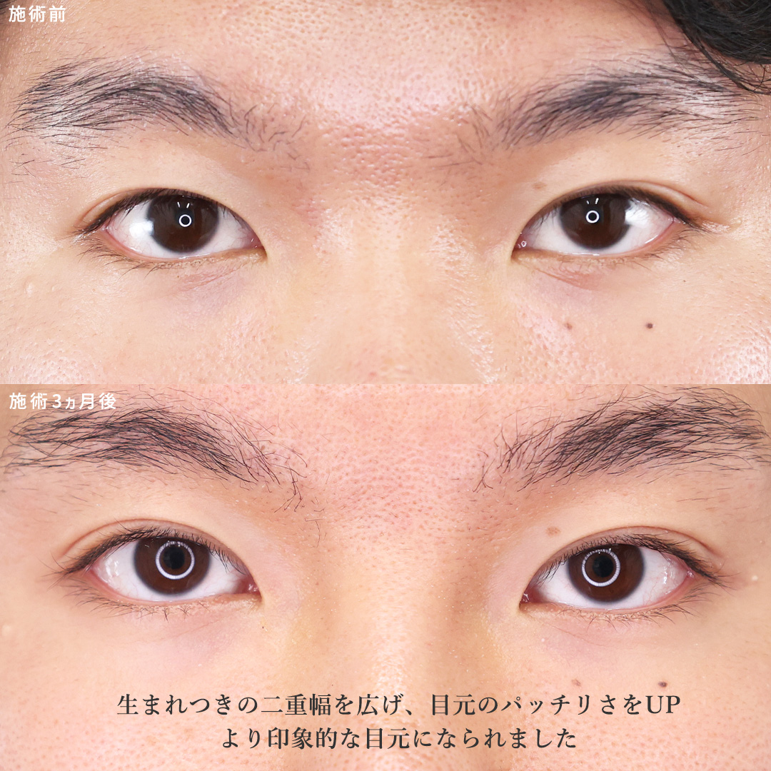 TAC式 ツヤ肌コラーゲンリフト®/ジョールファット除去/バッカルファット除去の症例写真 施術前後 