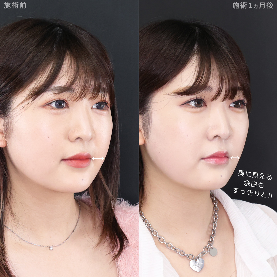 TAC式 ツヤ肌コラーゲンリフト®/ジョールファット除去/Lラインファット除去（エラ下脂肪除去）の症例写真 施術前後 
