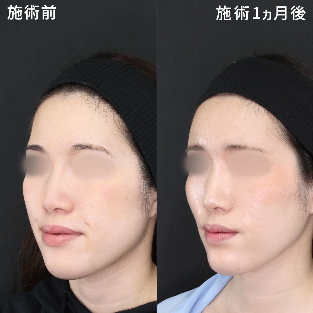【脂肪注入】丸い柔らかな印象｜オルチャンデコ
