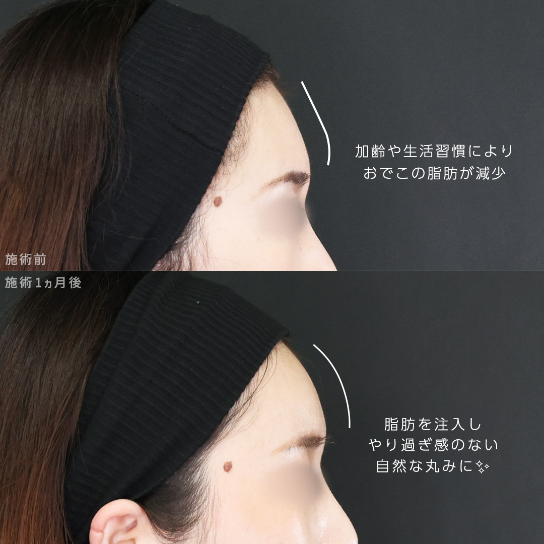 TAC式 ツヤ肌コラーゲンリフト®/ジョールファット除去/顔の脂肪注入(コンデンスリッチフェイス)の症例写真 施術前後 