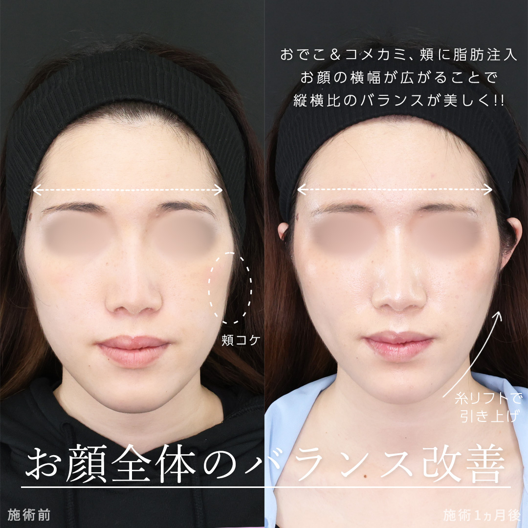 TAC式 ツヤ肌コラーゲンリフト®/ジョールファット除去/顔の脂肪注入(コンデンスリッチフェイス)の症例写真 施術前後 