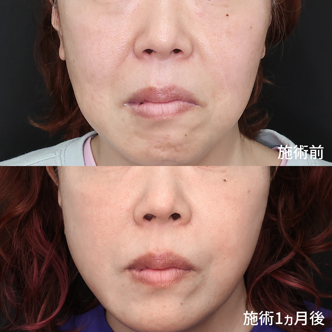 ほうれい線のヒアルロン酸注射の症例写真 施術前後 50代女性 1ヵ月経過 正面