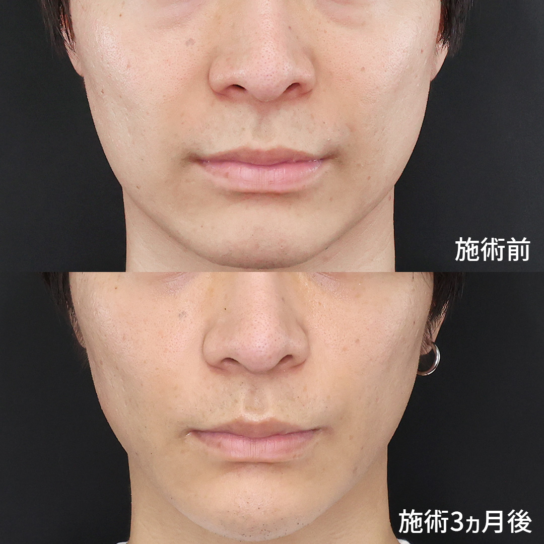 ほうれい線のヒアルロン酸注射の症例写真 施術前後 20代男性 3カ月経過 正面