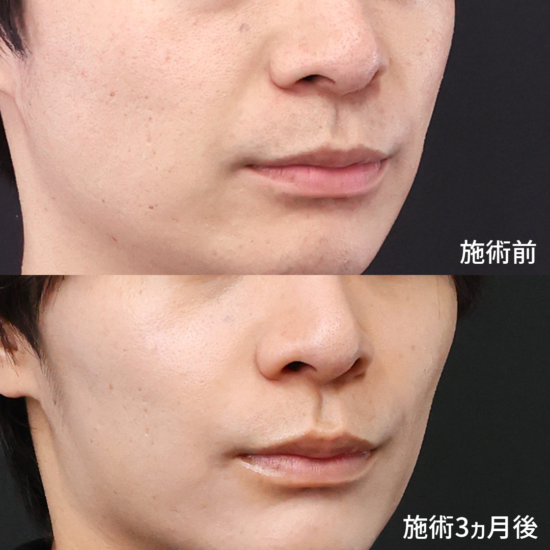 ほうれい線のヒアルロン酸注射の症例写真 施術前後 20代男性 3カ月経過 斜め