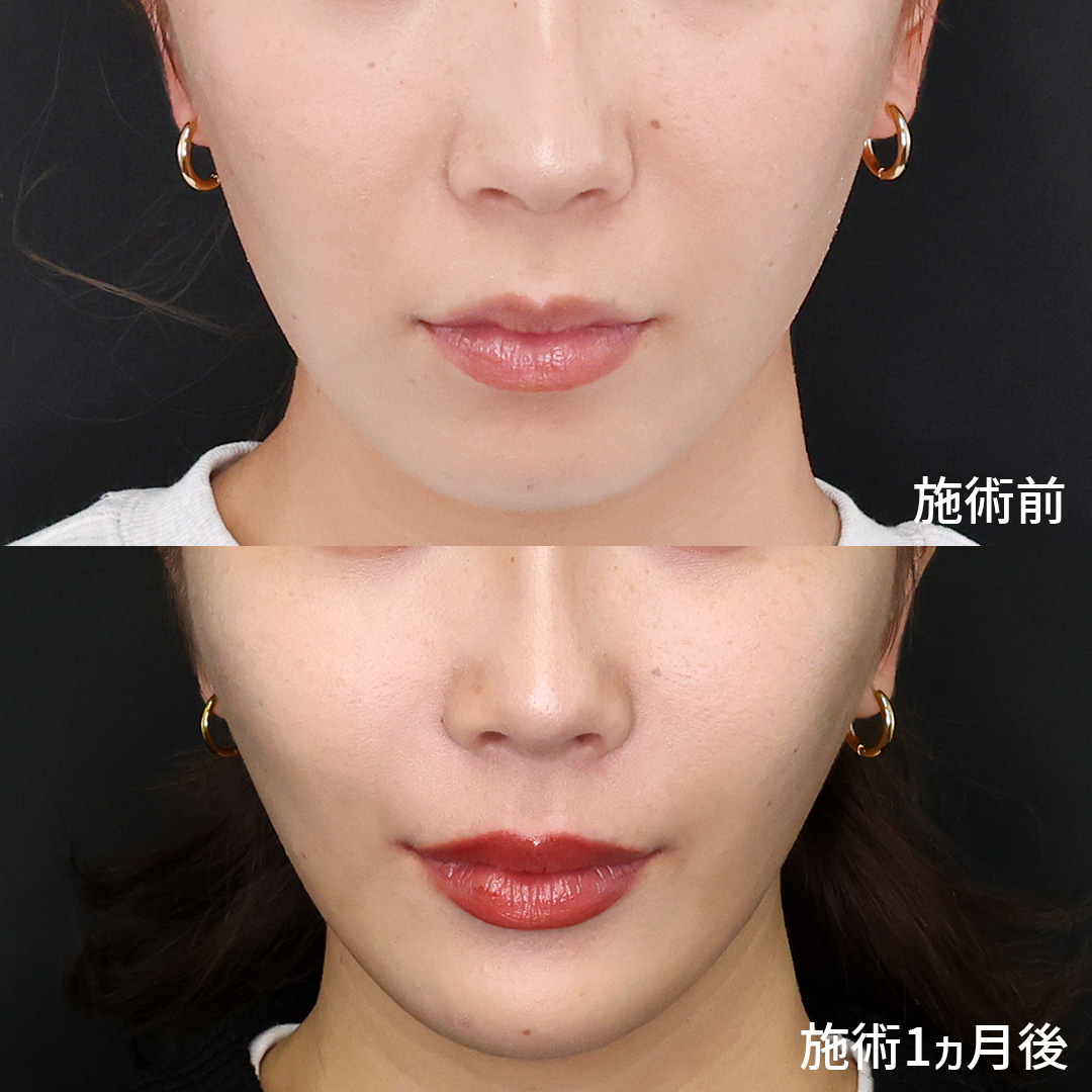 ほうれい線のヒアルロン酸注射の症例写真 施術前後 20代女性 1カ月経過 正面