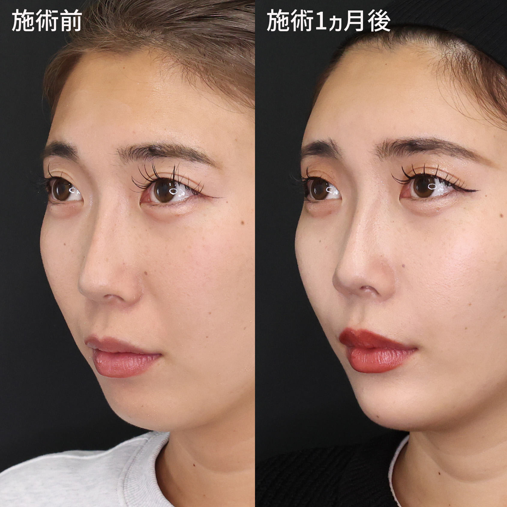 ほうれい線のヒアルロン酸注射の症例写真 施術前後 20代女性 1カ月経過 斜め