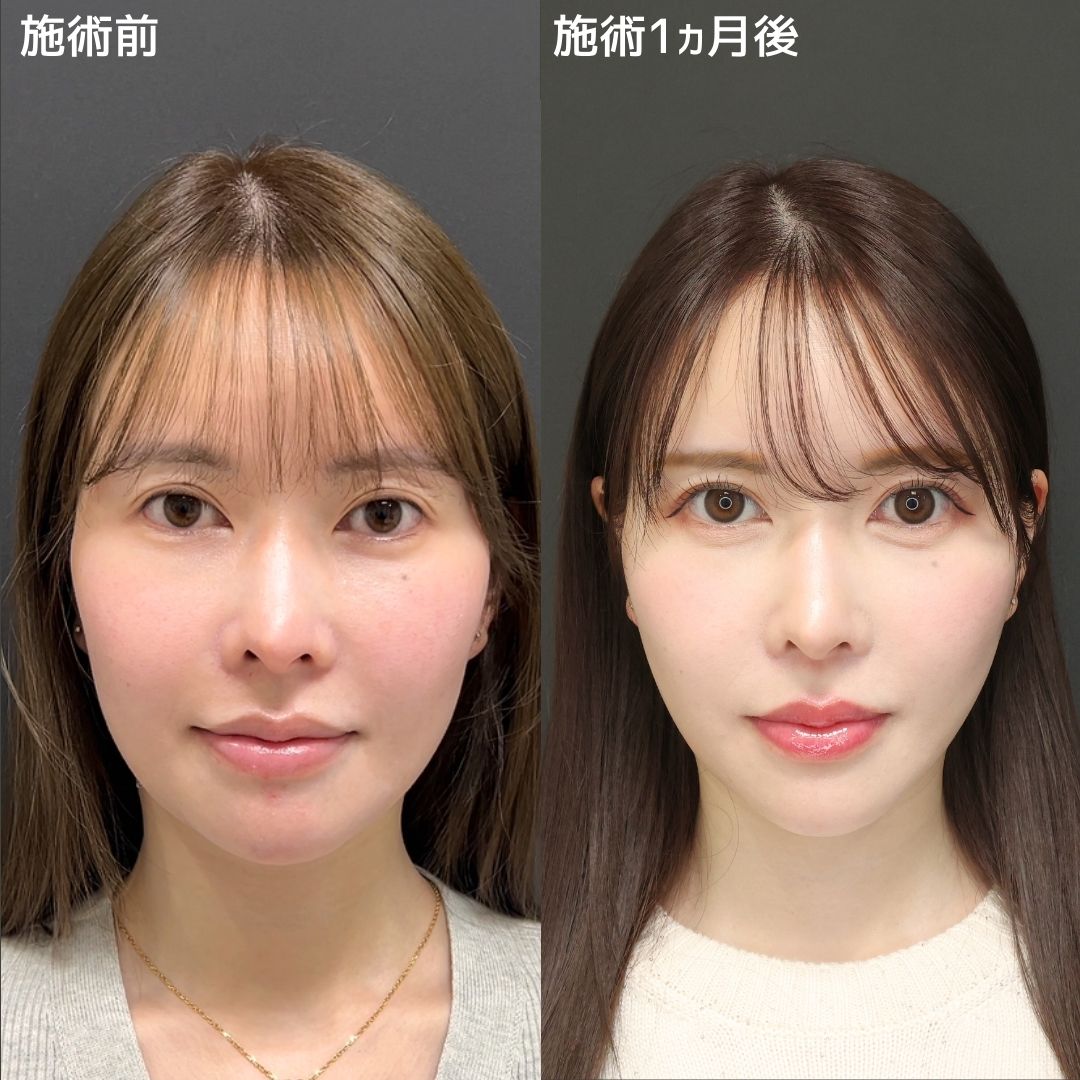 《15分で小顔術》糸リフトで自分にもっと自信が持てる