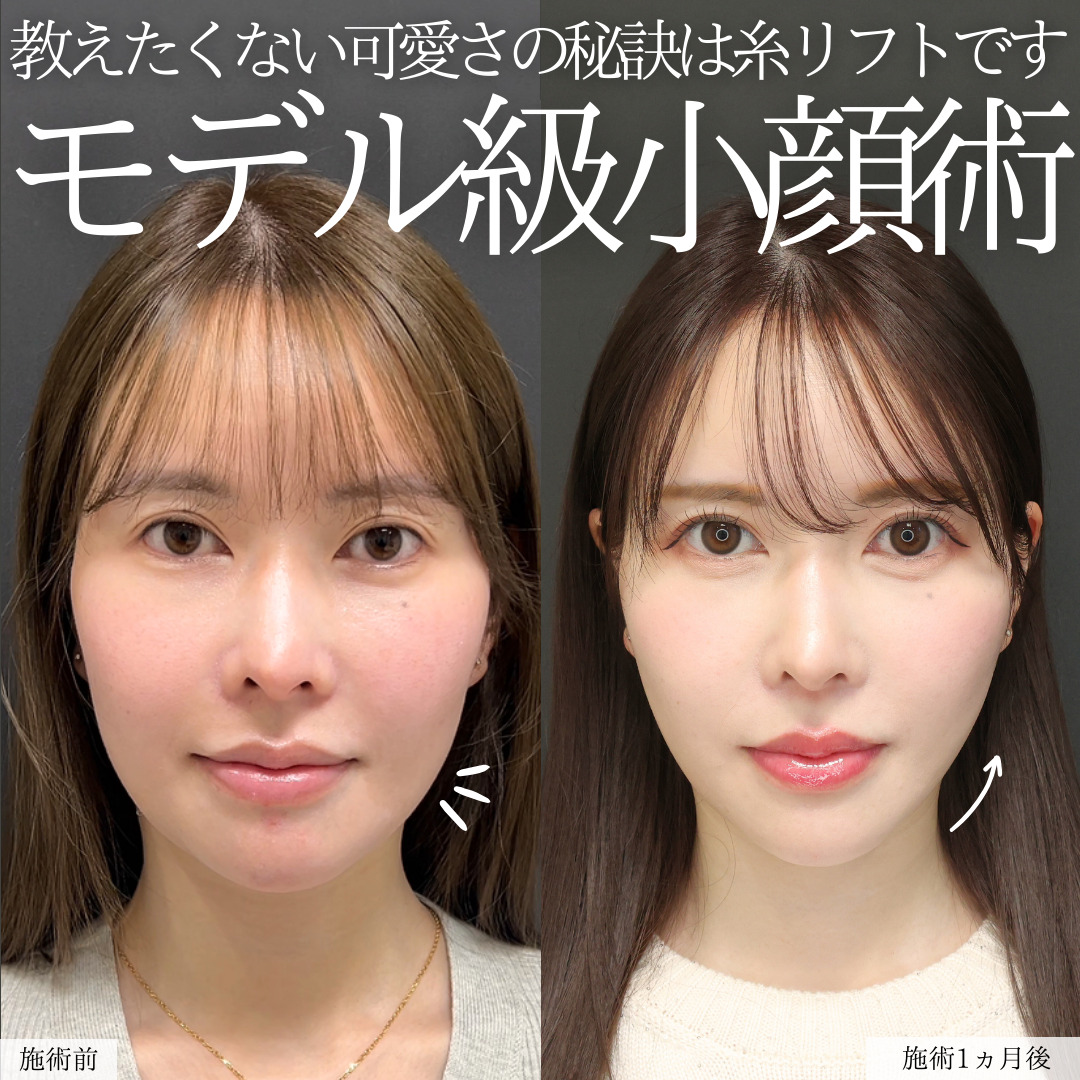 TAC式 ツヤ肌コラーゲンリフト®/エラボトックス注射の症例写真 施術前後 