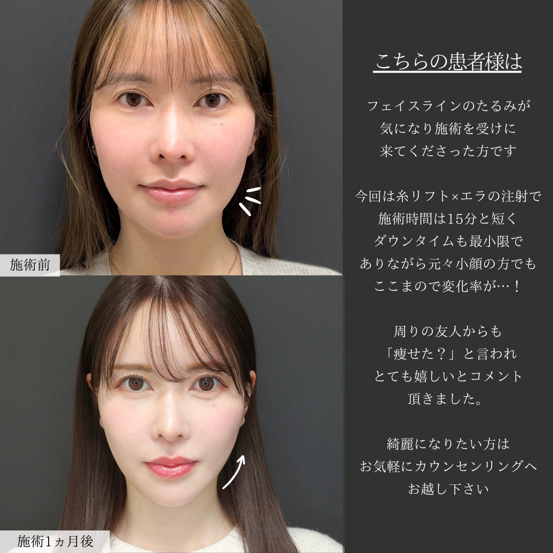 TAC式 ツヤ肌コラーゲンリフト®/エラボトックス注射の症例写真 施術前後 