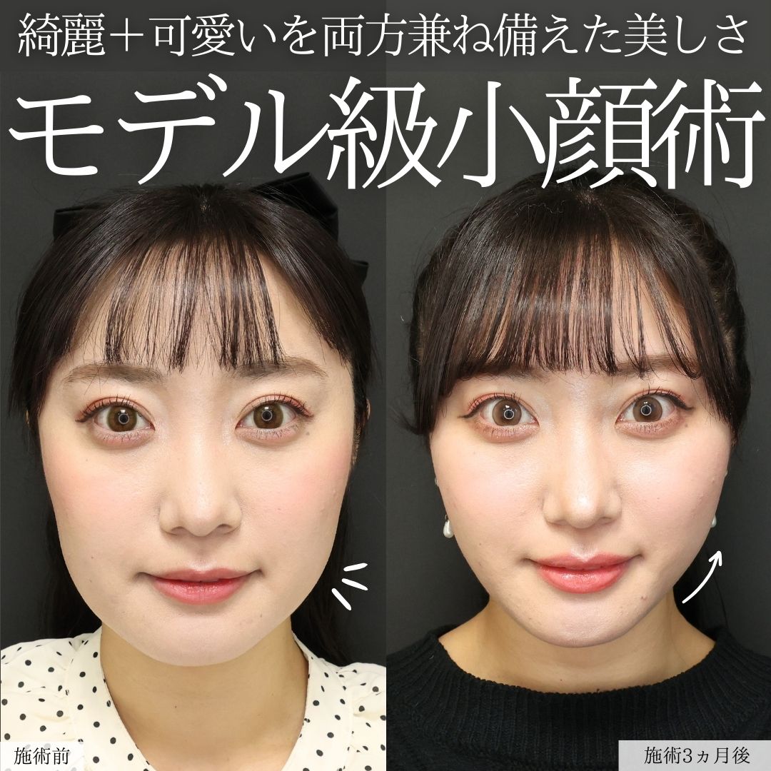 TAC式 ツヤ肌コラーゲンリフト®/ジョールファット除去/Lラインファット除去（エラ下脂肪除去）の症例写真 施術前後 