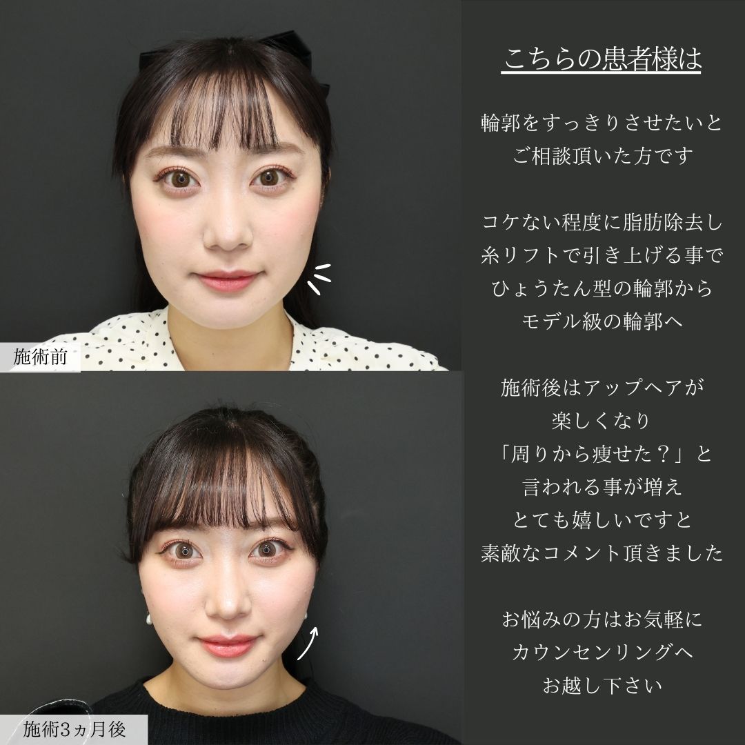 TAC式 ツヤ肌コラーゲンリフト®/ジョールファット除去/Lラインファット除去（エラ下脂肪除去）の症例写真 施術前後 