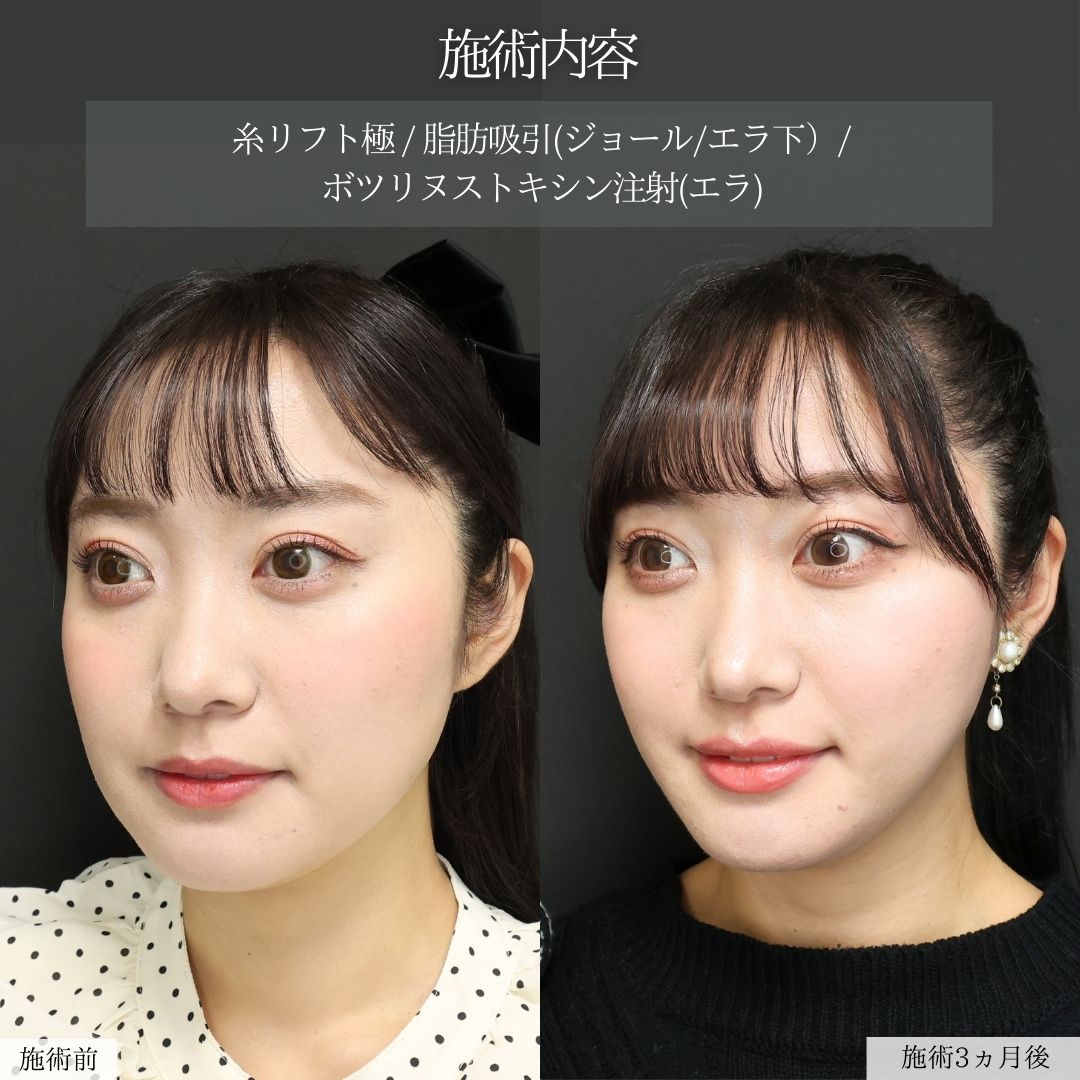 TAC式 ツヤ肌コラーゲンリフト®/ジョールファット除去/Lラインファット除去（エラ下脂肪除去）の症例写真 施術前後 