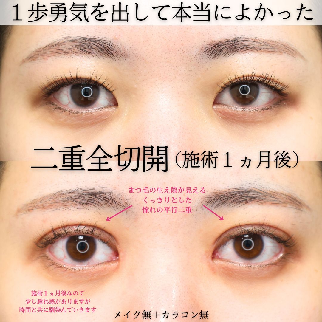 二重切開（全切開法）の症例写真 施術前後 
