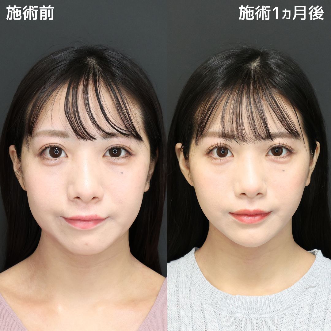 《小顔整形》さらに小顔で可愛さUP！