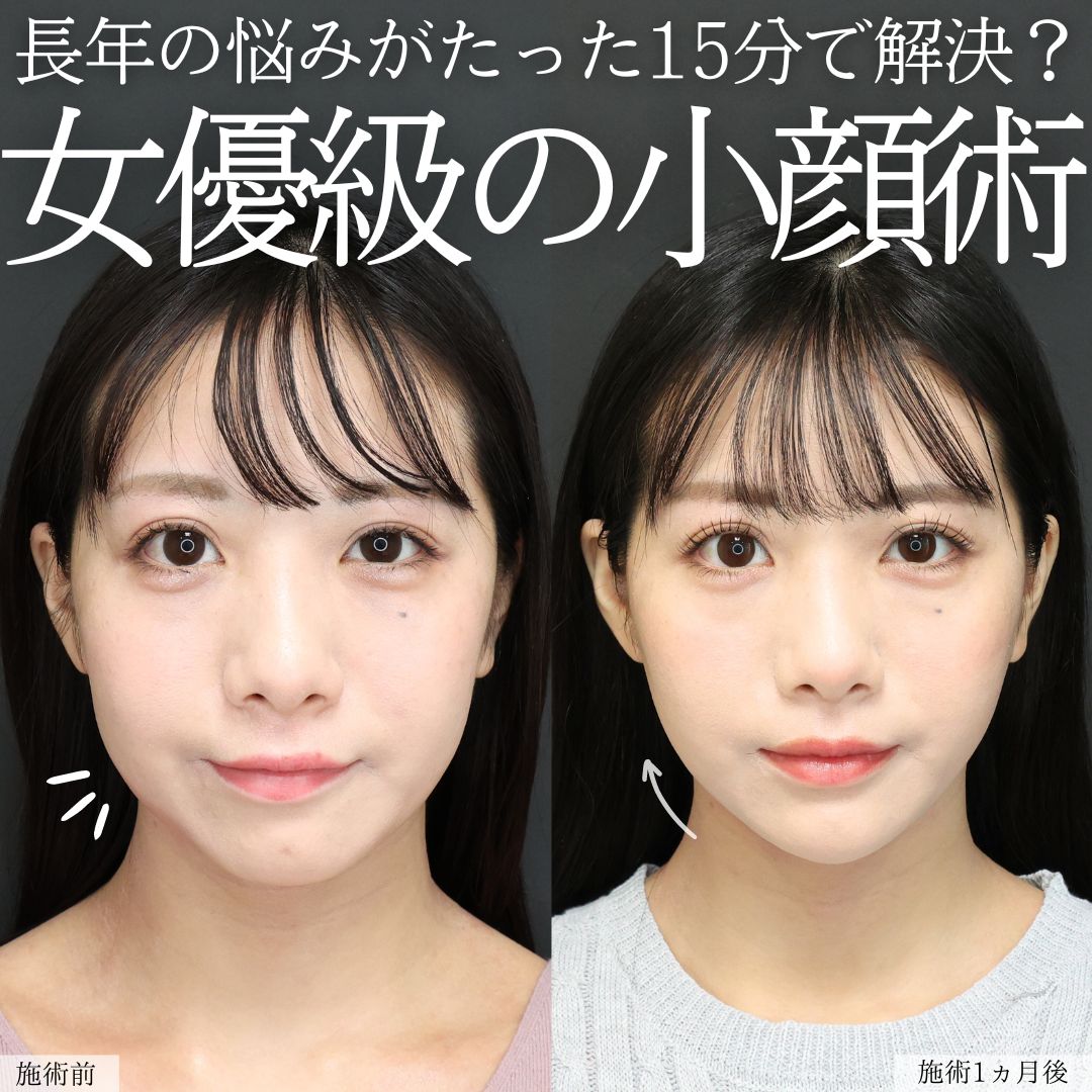 TAC式 ツヤ肌コラーゲンリフト®/顎のヒアルロン酸注射/エラボトックス注射の症例写真 施術前後 