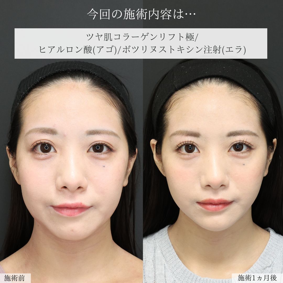 TAC式 ツヤ肌コラーゲンリフト®/顎のヒアルロン酸注射/エラボトックス注射の症例写真 施術前後 