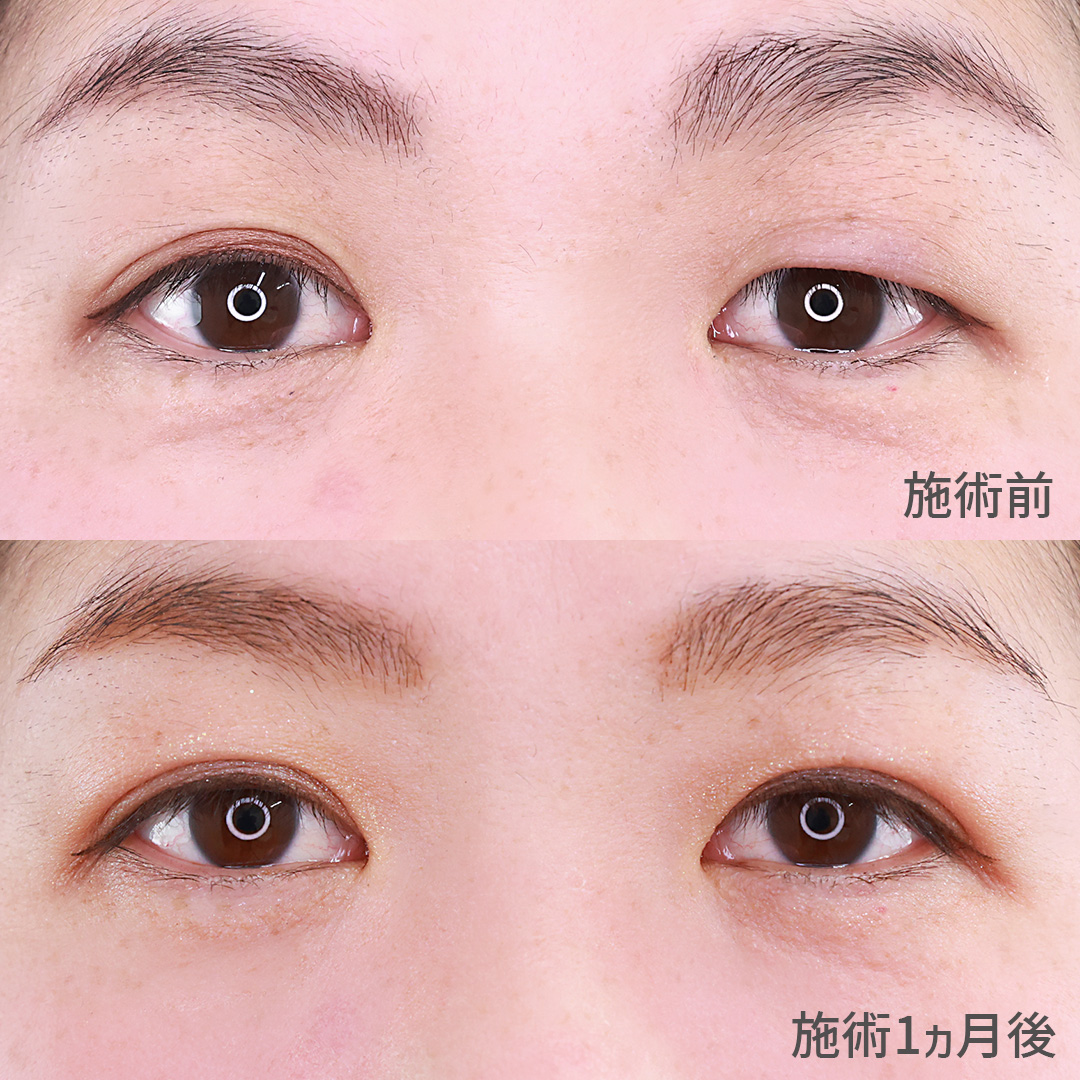 左右差のある目元の悩み【二重埋没法】でバランスとれた二重ラインへ