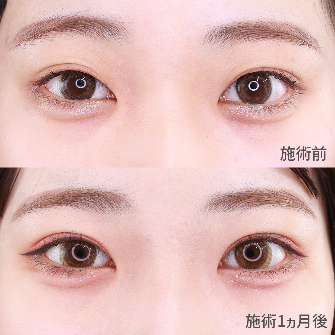 【二重埋没法】悩んでいた左右差改善、メイク映えする末広型二重まぶた