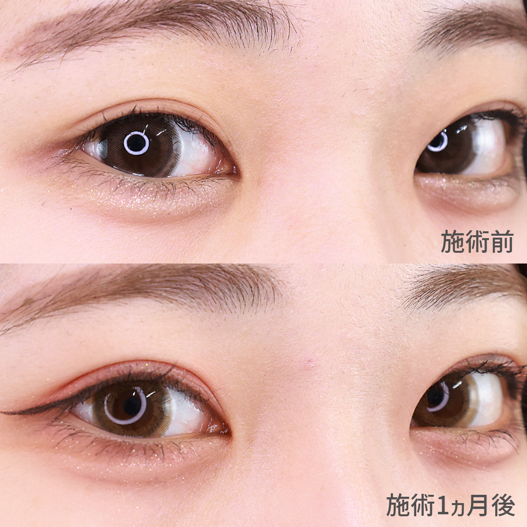 二重埋没法の症例写真 施術前後 