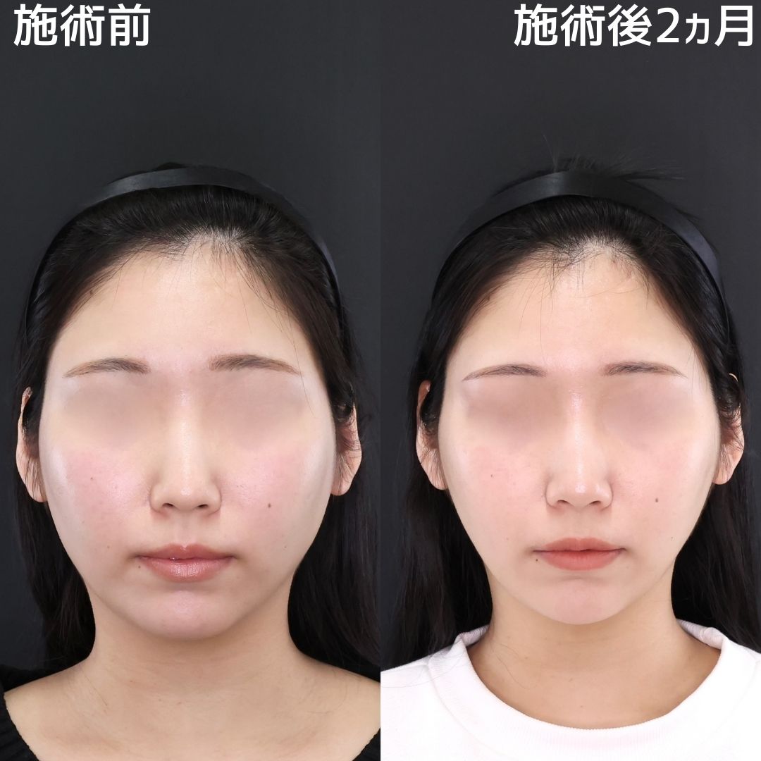 【糸リフト×アゴ下の脂肪吸引】もたつき0でさらに小顔へ